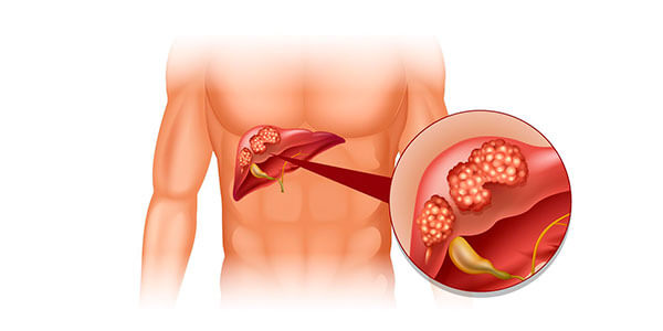 Осложнения после гепатита